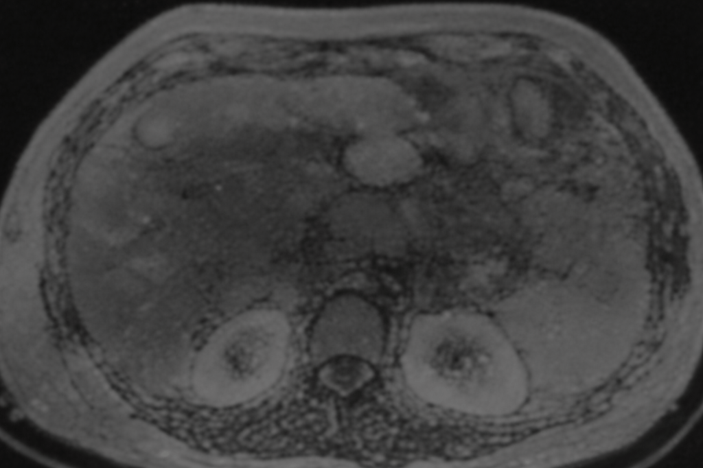 CT Scan for Malignancy